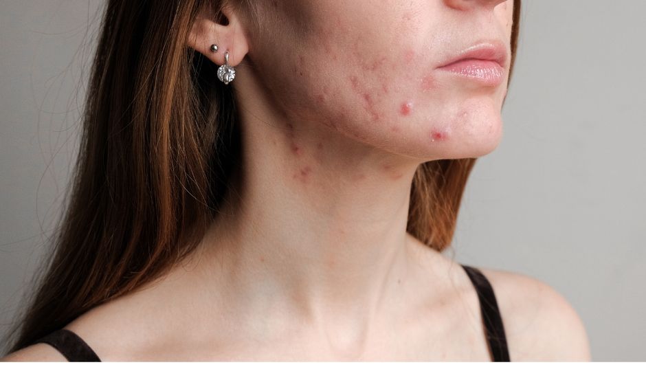 Rutina skincare piel acnéica o sensible
